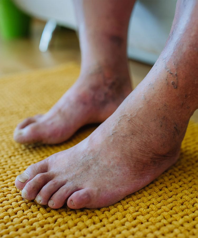 How Custom Insoles and Exercise Can Help With Diabetes