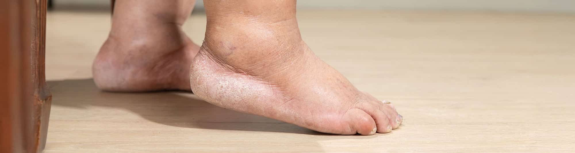 Insoles for Diabetes
