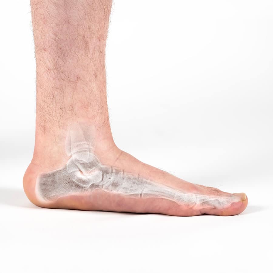 How Custom Insoles Can Help Flat Feet
