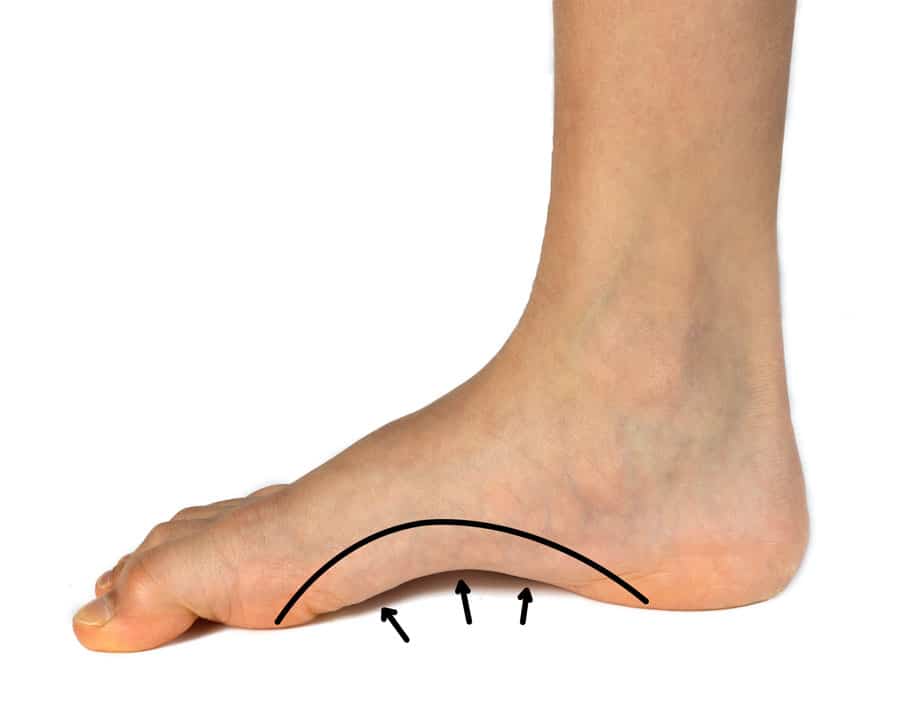 Understanding the condition and protecting your feet