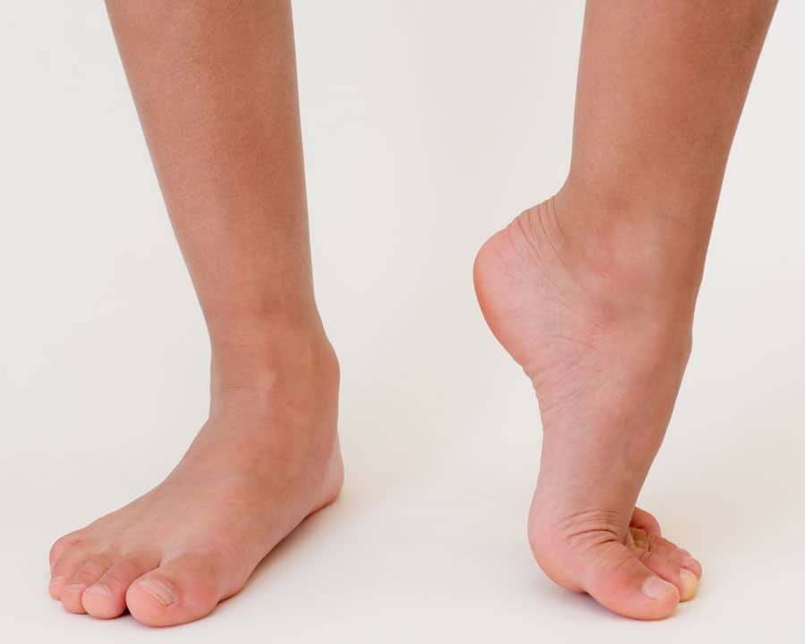 How High Arches Affect Overall Foot Health