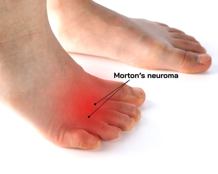 What Causes morton’s neuroma?